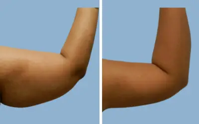 Before and After